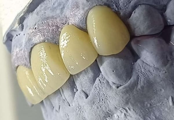 Carillas de Porcelanas (Diseño de Sonrisa)