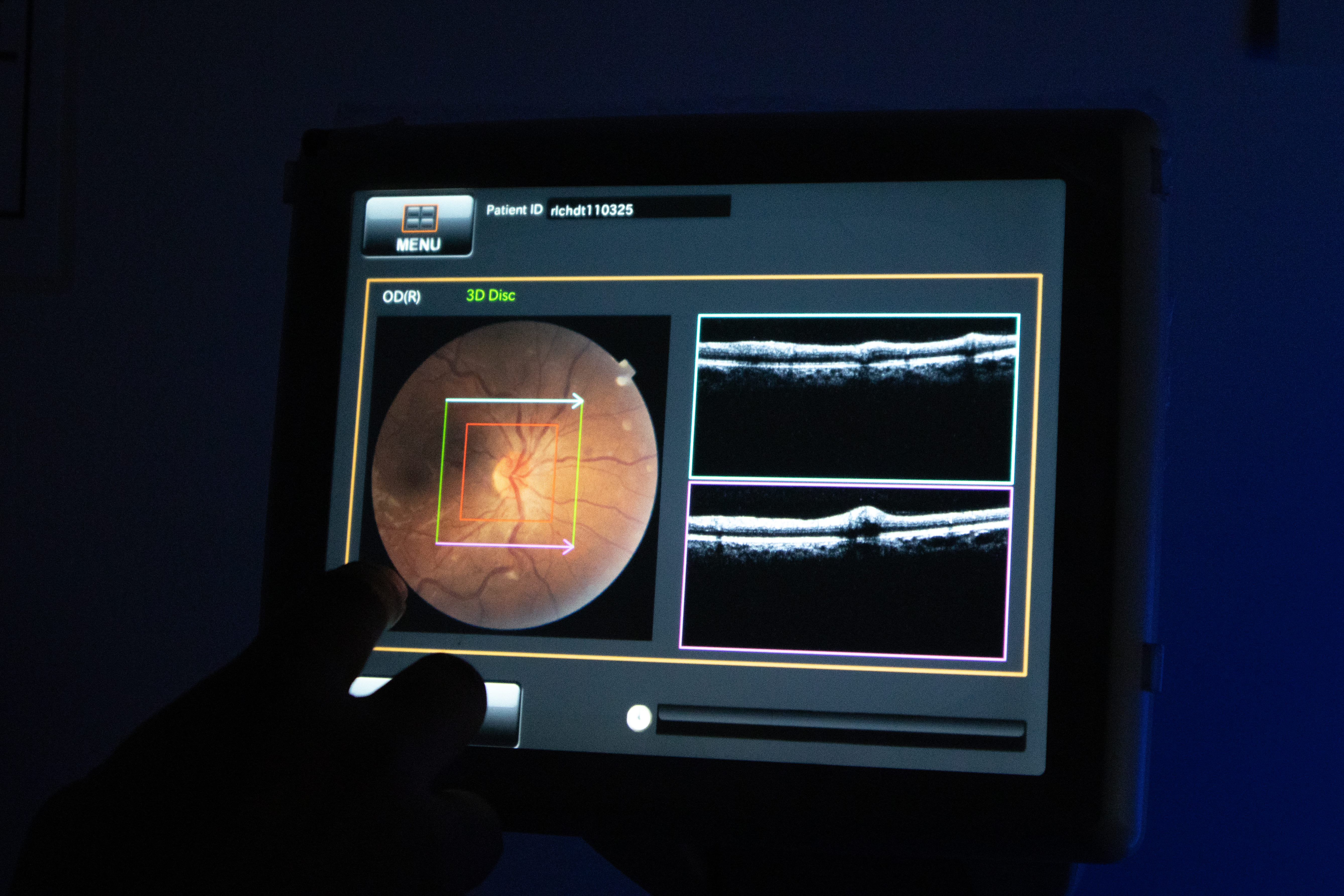 Topografía Corneal