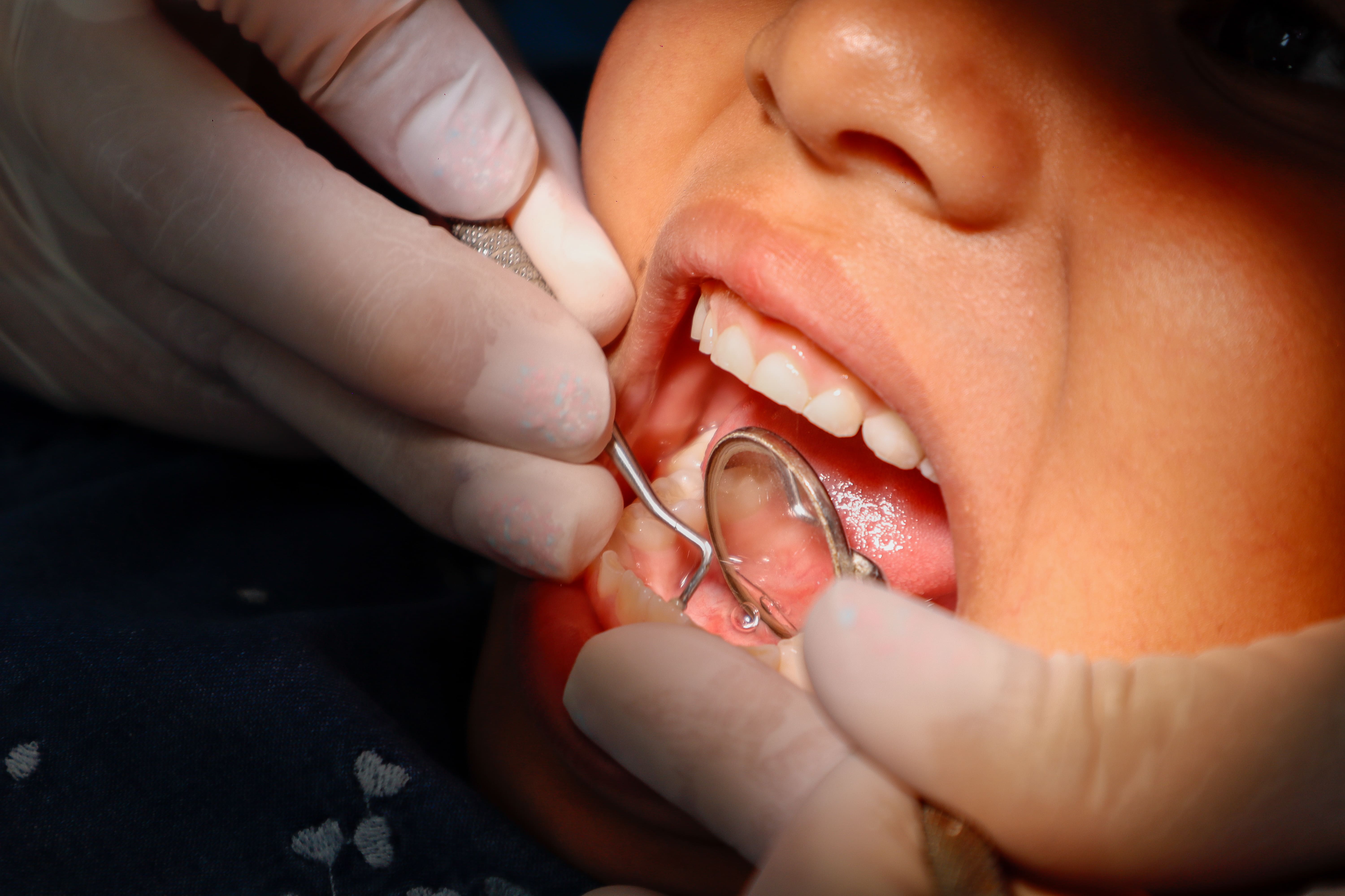 Profilaxis Dental