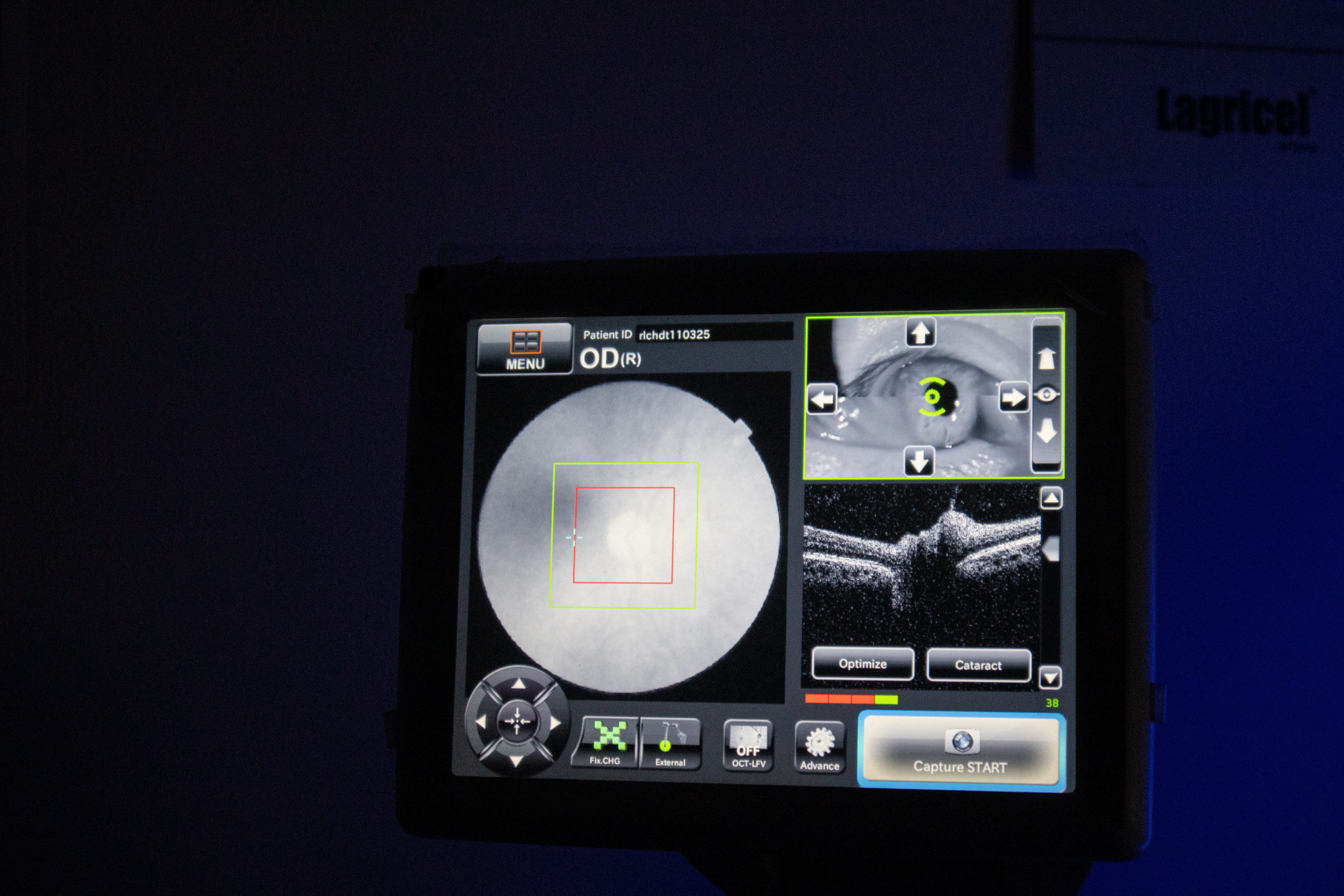 Tomografía Ocular Computarizada de Nervio y Macula (OCT)