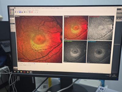 Fotografía del Fondo de Ojo